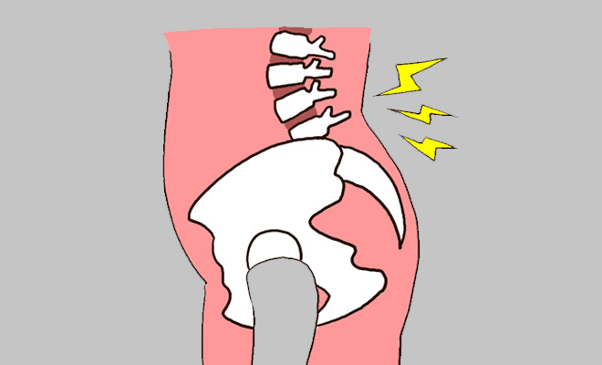 骨盤前傾のひどい反り腰で腰痛になっているイメージ